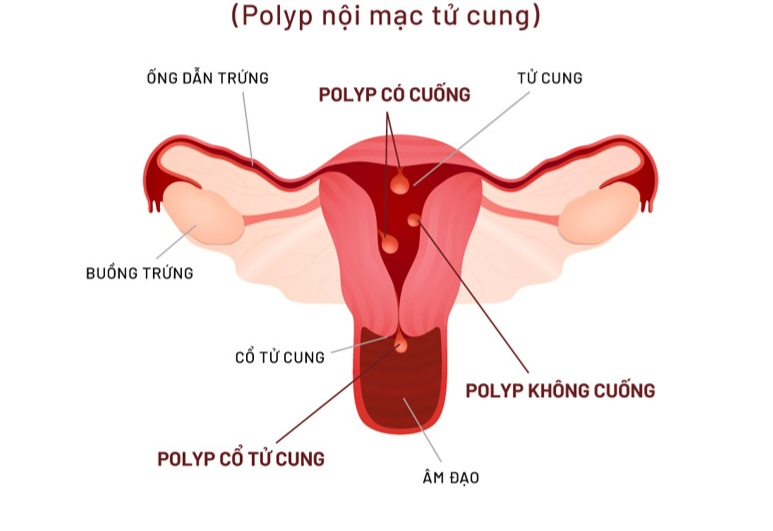 Polyp tử cung có ảnh hưởng đến khả năng sinh sản?