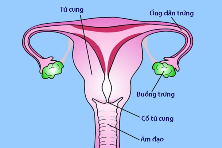 Viêm vùng chậu là bệnh gì, có gây vô sinh không?