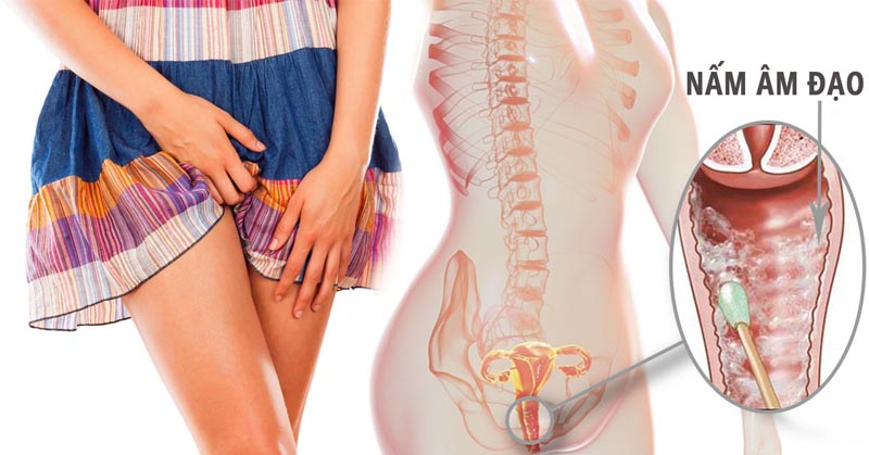 Cách đơn giản giúp chị em phòng bệnh nấm âm đạo