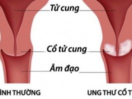 VIÊM ÂM ĐẠO DẪN TỚI VÔ SINH & UNG THƯ CỔ TỬ CUNG